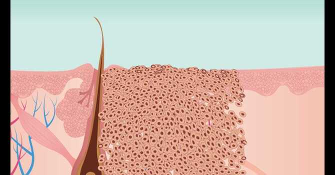 Swift Microwave Therapy