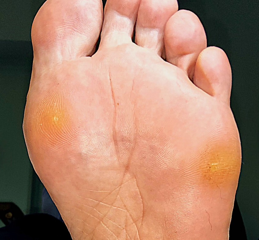 hard skin, callus, corns, painful feet