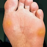 hard skin, callus, corns, painful feet